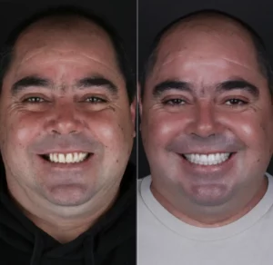 Prótese Fixa sobre Implantes