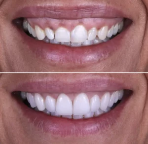 Facetas Dentárias