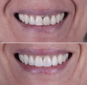 Facetas Dentárias