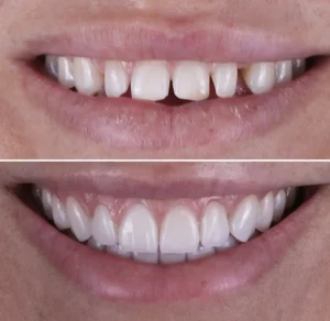 Facetas Dentárias
