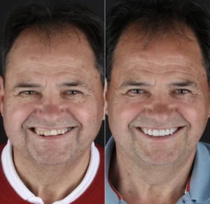 Facetas Dentárias