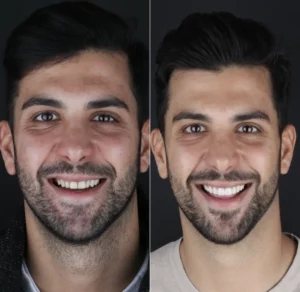 Facetas Dentárias