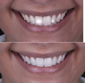 Remoção de manchas no esmalte